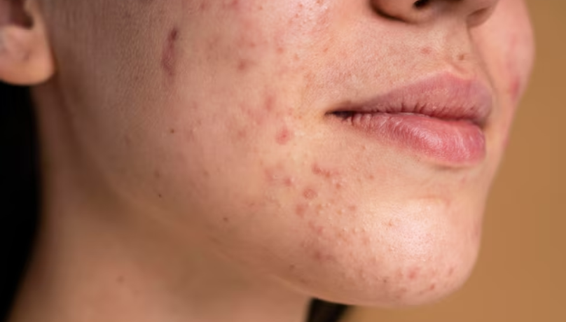 Acne & Scar Treatment