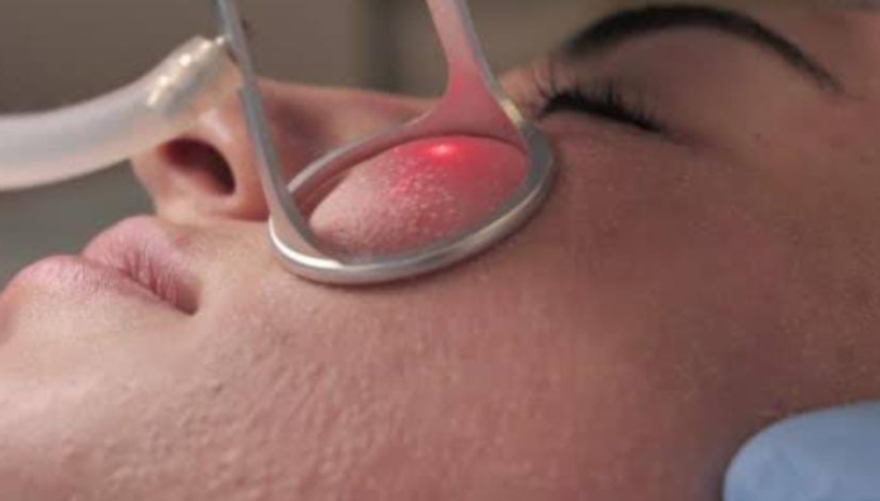 CO2 Fractional Laser